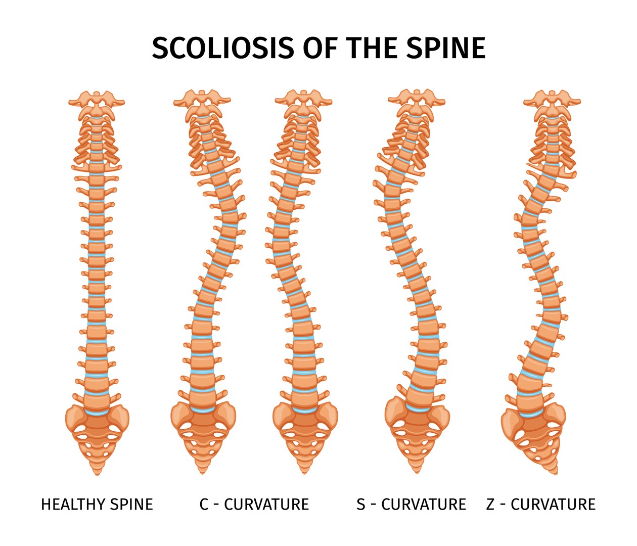 tipuri de scolioza